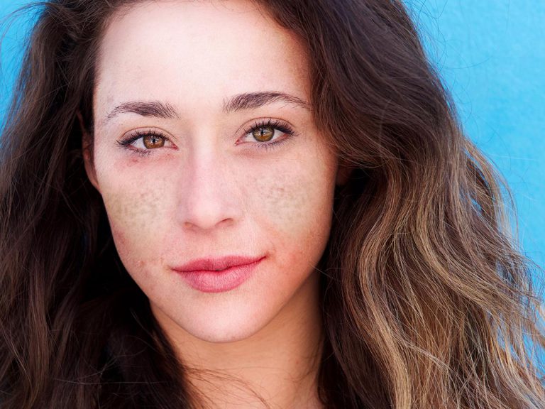 Methode gegen Sommersprossen, Verfärbungen, Falten und fettige Haut – Cosmelan-Behandlung